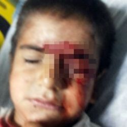 Şırnak'ta 6 yaşındaki bir çocuk gözünden yaralandı