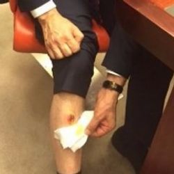 AK Partili vekil ısırıldığına dair Adli Tıp raporu aldı