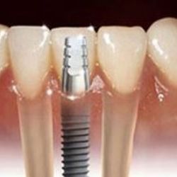 İmplantta lazer avantajı