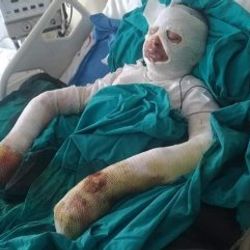 Lise öğrencisi bitlerden kurtulmak isterken tutuştu
