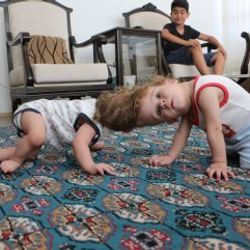 Antalya'da kafadan yapışık siyam ikizleri 1 yaşında