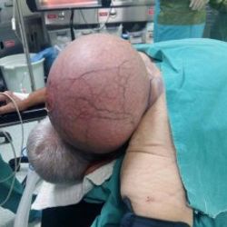 50 yıldır ensesinde 4 kiloluk kitle taşıyordu