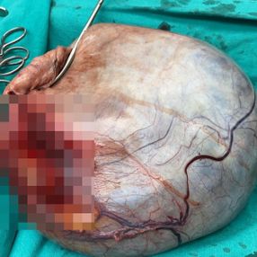 Samsun'da hamile sanılan kadının karnından kitle çıktı