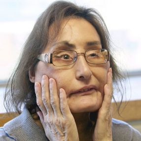 ABD’de ilk yüz nakilli Connie Culp, hayatını kaybetti