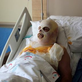Ardahan'da çay demlemek için sobaya benzin döktü: Yandı