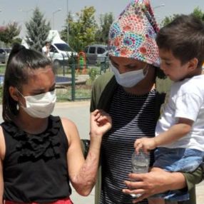 Diyarbakır'da üzerine kazan devrilen Zeynep yardım bekliyor