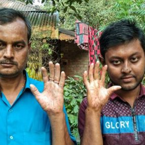 Bangladeş’teki bir ailede, erkeklerin parmak izi yok