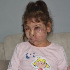 Karabük'te Mikrosefali hastası Sahra, yardım bekliyor
