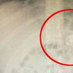 Kosova'da midesinden Nokia 3310 çıktı