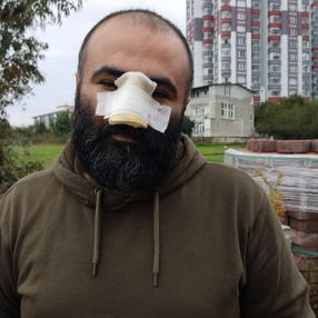 Samsun’da tasmasız pitbull, Azerbaycanlı iş insanının burnunu kopardı