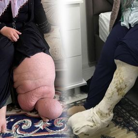 Muş'taki fil hastası, 21 yıl sonra ayakkabı giyme hayaline kavuşuyor