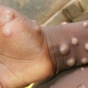 Afrikalı basın mensupları maymun çiçeği virüsü nedeniyle tepkili