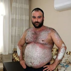 Sedef hastalığına yakalandı, yardım bekliyor