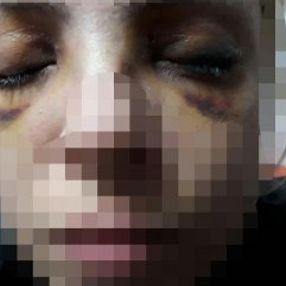Şizofreni hastasının saldırısına uğrayan kadın konuştu