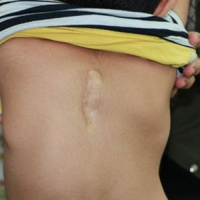 Adana'da skolyoz hastası Cihan'ın ailesi yardım bekliyor