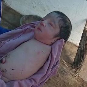 Hindistan’da kolları ve bacakları olmadan doğan bebek