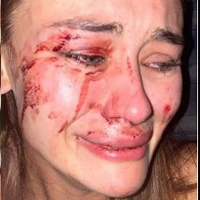 Top model Daria Kyryliuk Çeşme'de saldırıya uğradı