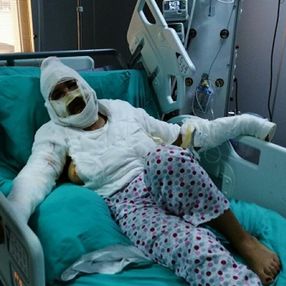 İstanbul'da yüzüne kızgın yağ attığı erkek arkadaşı ceza aldı, kadının tepkisi pes dedirtti