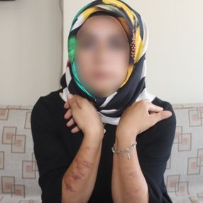 Adıyaman'da lazer yaptıran genç kadının vücudu yandı