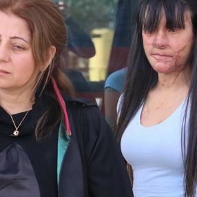Yüzüne asit atan sevgilisini affeden Berfin: Çok pişmanım