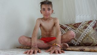 Hakkarili Amar, arkadaşlarının dalga geçtiği hastalıktan kurtulmak istiyor