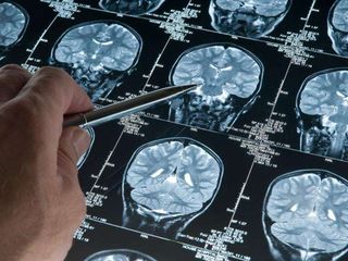 Alzheimer riskini artıran genetik varyant bulundu
