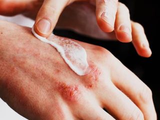 Egzamayı en hızlı ne geçirir? İşte etkili çözümler