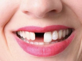 Diş eksikliği, yüz estetiğinde bozulmaya neden oluyor