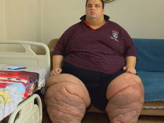İstanbul'da yaşayan Mehmet, fil hastalığı nedeniyle 270 kiloya çıktı