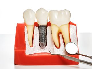 Diş tedavisinde yeni dönem: İmplant SSK kapsamına giriyor