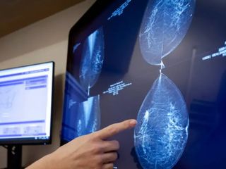 Yeni yapay zeka modeli 5 yıla kadarki meme kanseri riskini tahmin ediyor