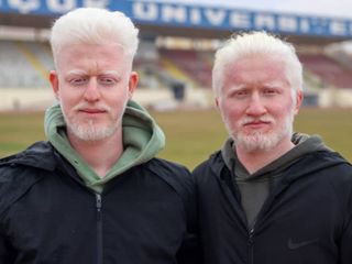 Albinizmli üniversite öğrencileri Muhammet ve Yusuf'un dayanışma hikâyesi