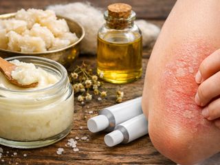 Kuyruk yağı kremi egzama tedavisinde sorun oluşturabilir