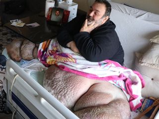 Kayseri'de fil hastası adam 300 kiloya ulaştı: 5 yıldır dışarı çıkamıyor