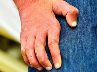 Romanya ve Hırvatistan'da 40 yılın ardından cüzzam vakaları görüldü