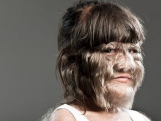 Nadir hastalıklara yüksek teknoloji umudu