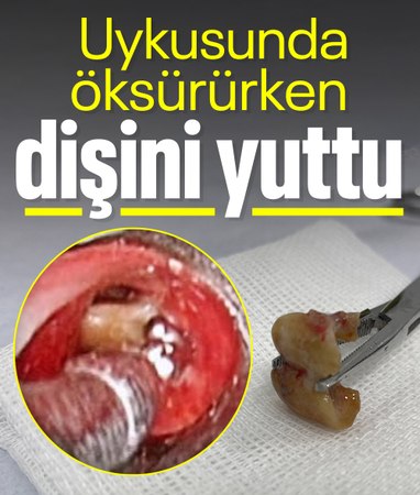 İstanbul'da uykusunda iki dişini yuttu, soluğu hastanede aldı