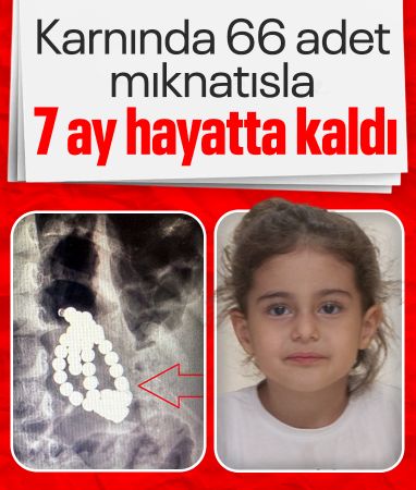 İstanbul'da 3 yaşındaki Berfin karnında 66 adet mıknatısla aylarca hayatta kalmış