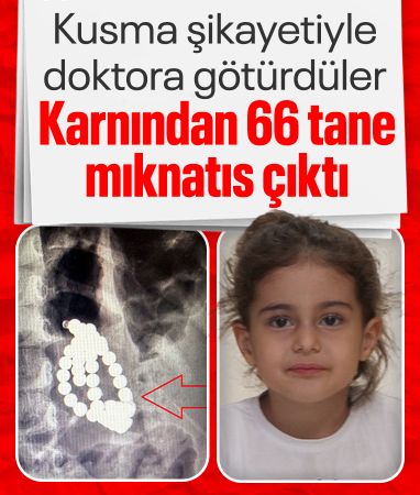 İstanbul'da 3 yaşındaki Berfin karnında 66 adet mıknatısla aylarca hayatta kaldı