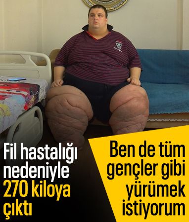 İstanbul'da yaşayan Mehmet, fil hastalığı nedeniyle 270 kiloya çıktı