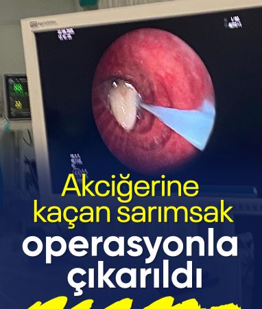 Osmaniye'de hastanın akciğerine kaçan sarımsak, operasyonla çıkarıldı