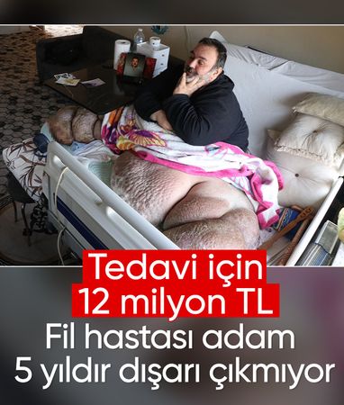 Kayseri'de fil hastası adam 300 kiloya ulaştı: 5 yıldır dışarı çıkamıyor