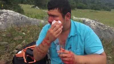 Kocaeli'de Lütfü Türkkan'ın adamlarının darbettiği muhabirin yara izleri geçmeyecek