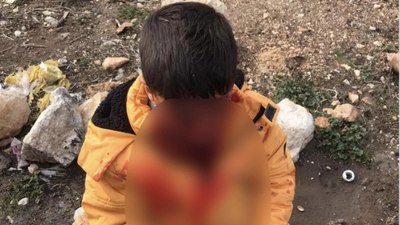 Adıyaman'da çocuğa saldıran başıboş köpek kuduz çıktı