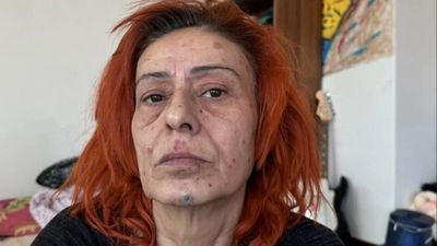 Boya yüzünden yüzü yanmıştı! Yıldız Tilbe'den yeni açıklama geldi