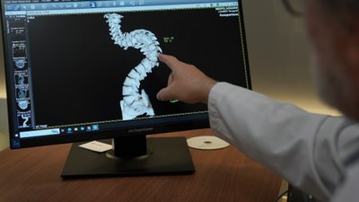 Skolyoz hastalığında erken teşhisin önemi