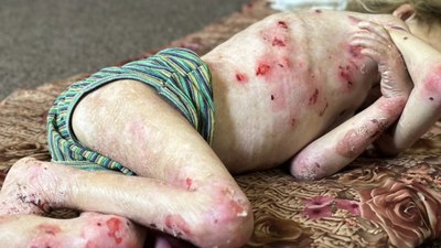 Gazze'de çocuklar hem açlık hem de hastalıkla mücadele ediyor