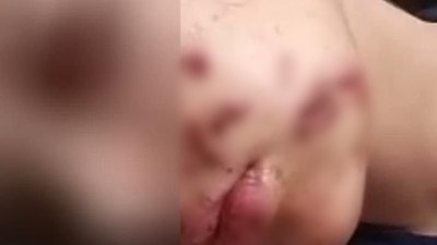 Siirt'te yüzüne maytap isabet eden genç kız yaralandı