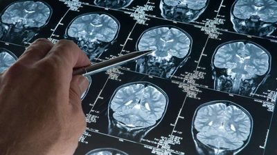 Alzheimer riskini artıran genetik varyant bulundu