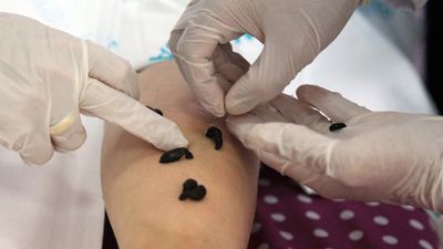 Sülük tedavisi caiz midir? Diyanet yanıtladı: Sülükle tedavinin hükmü...